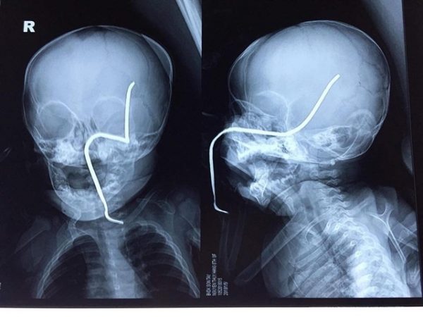 Một bé gái bị thanh sắt rỉ đâm thủng sọ